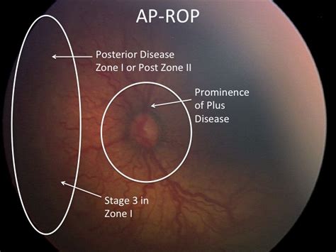 Image result for Rop Optos