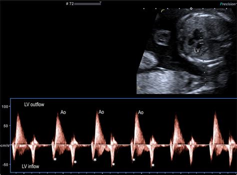 Image result for Heart Dissection Inflow Outflow Method