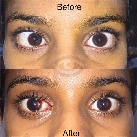 Before After - Dr. Pallavi Singh - MD, FICO