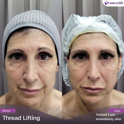 Spring Thread Lift Before and After に対する画像結果