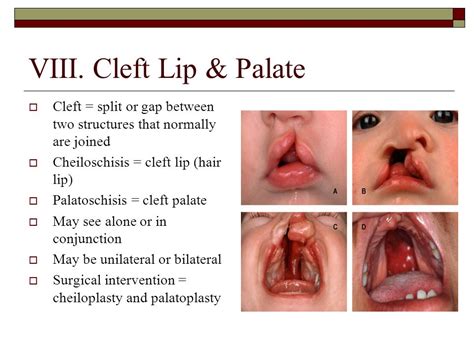 Image result for Palatoschisis Types