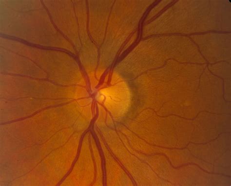 Normal Optic Nerve Optos に対する画像結果