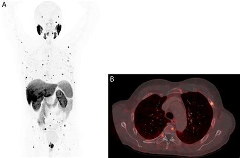 Toradh íomhá ar Radionuclide Bone Scan