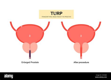 Turp Procedure Explained に対する画像結果