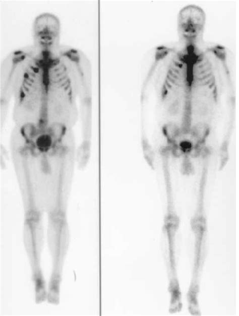 Toradh íomhá ar Radionuclide Bone Scan