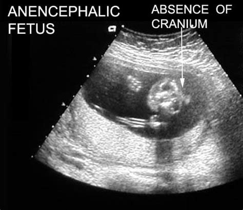 Image result for Anencephaly 8 Week Ultrasound