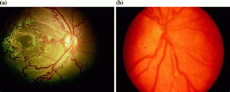 Image result for Rop Optos