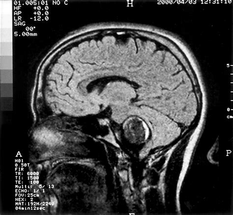 Image result for Brain Stem Compression