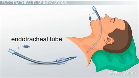 Image result for Different Types of Intubation