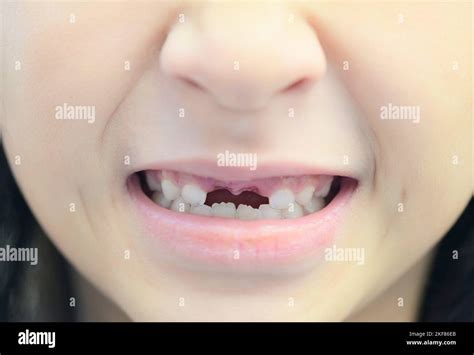 Afbeeldingsresultaten voor Side Tooth Fell Out