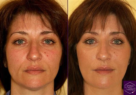 Spring Thread Lift Before and After に対する画像結果