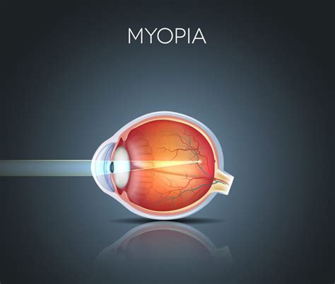 Image result for Blurred Vision Problems