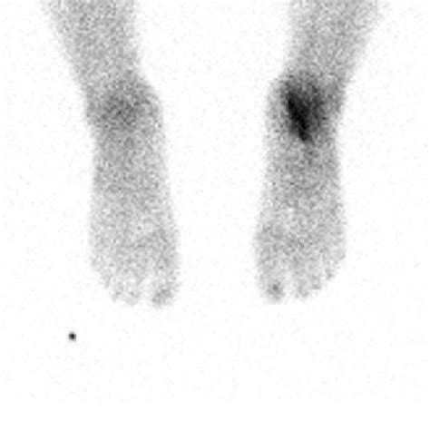 Toradh íomhá ar Radionuclide Bone Scan
