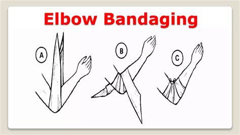 Advanced Bandaging Tutorial に対する画像結果
