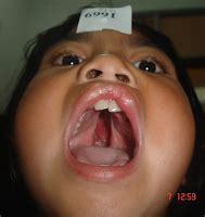 Image result for Palatoschisis Types