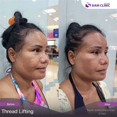 Spring Thread Lift Before and After に対する画像結果