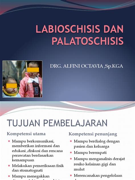 Image result for Palatoschisis Types