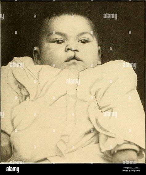 Image result for Palatoschisis Types