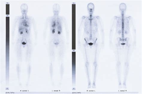 Toradh íomhá ar Radionuclide Bone Scan