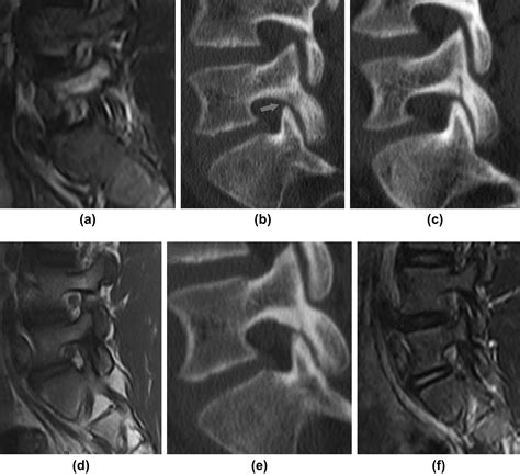 Modic III に対する画像結果