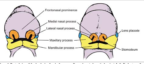 Image result for Palatoschisis Types