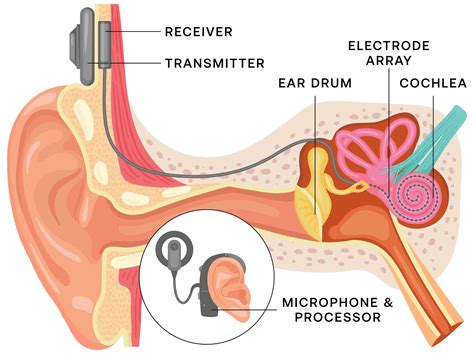 Inner Ear Fluid Buildup に対する画像結果
