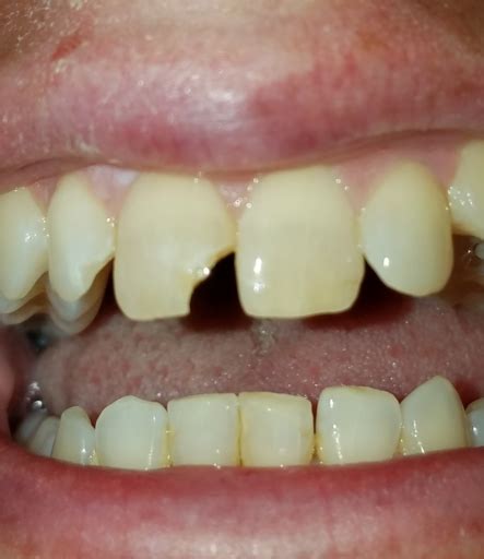 Image result for Cracked Tooth From Chewing Ice