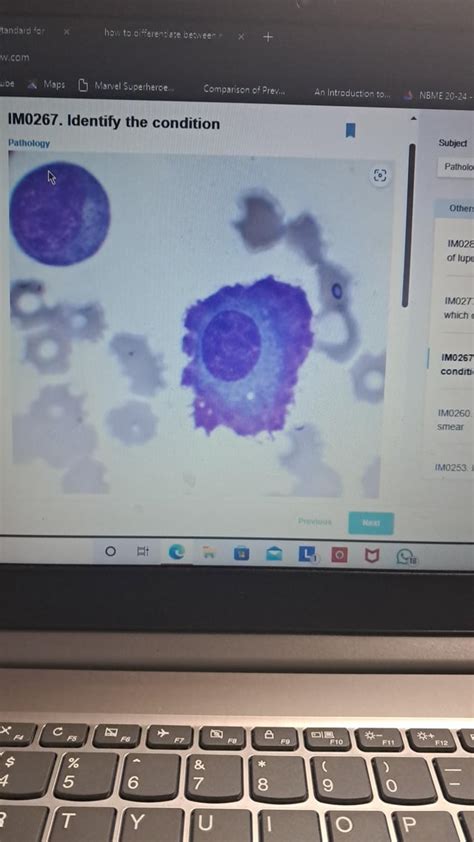 Image result for Flame Cells Multiple Myeloma