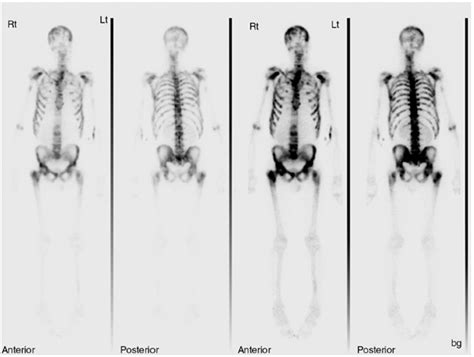 Toradh íomhá ar Radionuclide Bone Scan