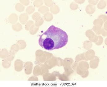 Image result for Flame Cells Multiple Myeloma