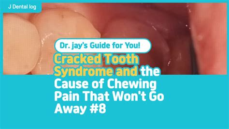 Image result for Cracked Tooth From Chewing Ice