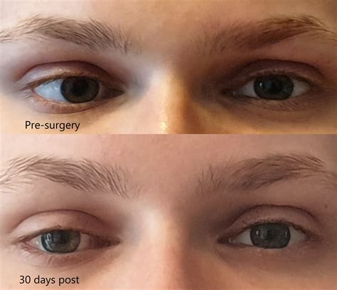 Image result for Strabismus Surgery