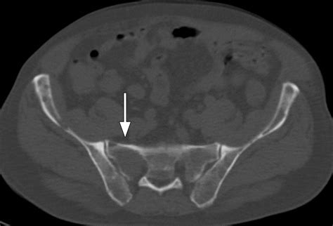 Image result for Multiple Myeloma Imaging