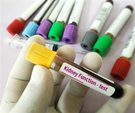 Image result for Acute Kidney Failure Diagnostic Test