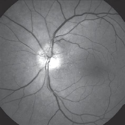 Image result for Aion Visual Field