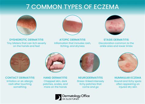 What Does Eczema Look Like に対する画像結果