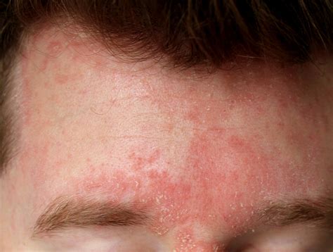 Image result for Sebaceous Dermatitis