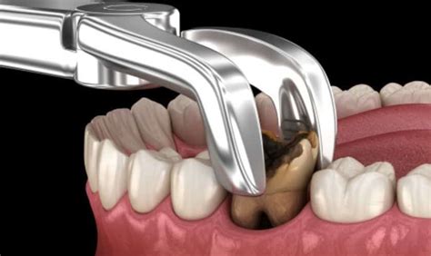 Image result for Self Tooth Extraction