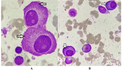 Image result for Flame Cells Multiple Myeloma