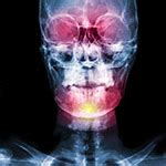 Image result for Palatoschisis Types