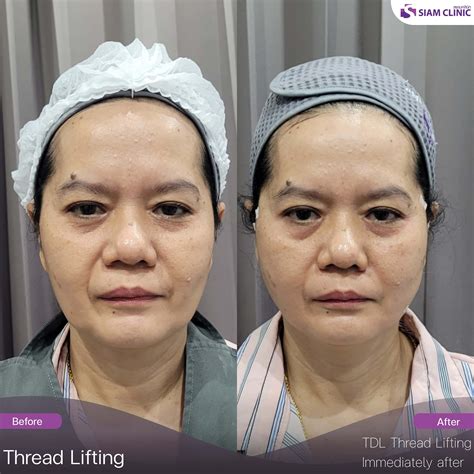 Spring Thread Lift Before and After に対する画像結果