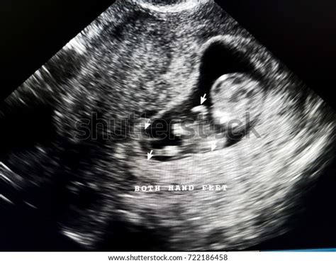 Afbeeldingsresultaten voor Ultrasound ID Code Roblox