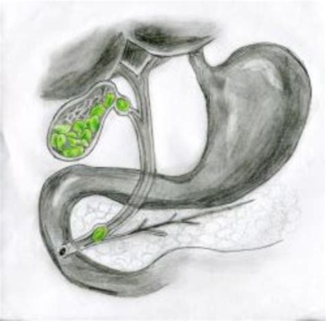 Image result for Gallbladder Skin Rash