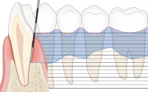 Toradh íomhá ar Perio Protocol Flow Chart