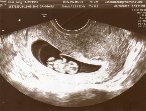 Image result for Anencephaly 8 Week Ultrasound