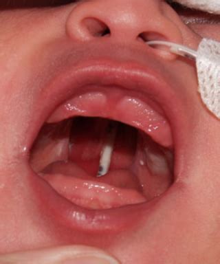 Image result for Palatoschisis Types