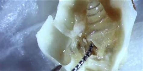 Image result for Linsday Wagner Bionic Ear