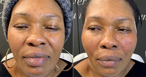 Spring Thread Lift Before and After に対する画像結果