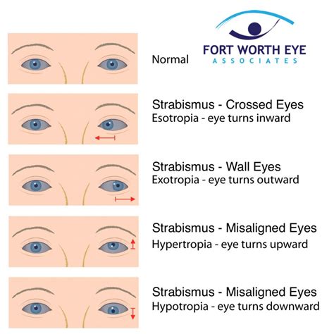 Image result for Strabismus Surgery