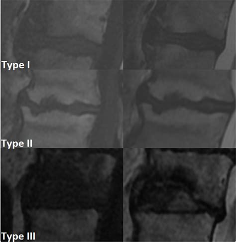 Modic III に対する画像結果